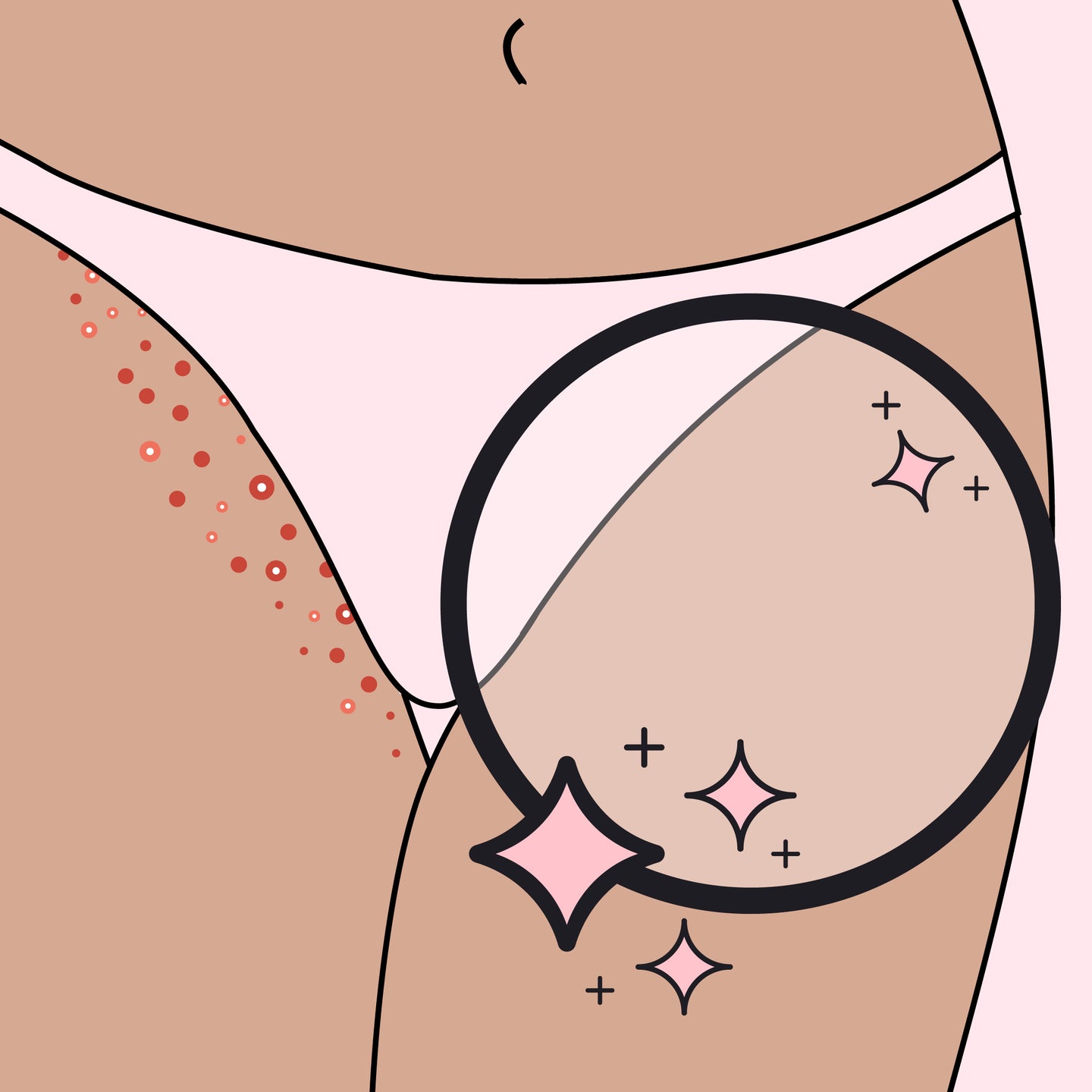 illustration depicting the results of an effective bikini line razor bump remedy