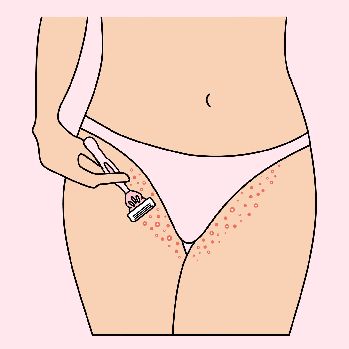 illustration depicting bikini line razor bumps