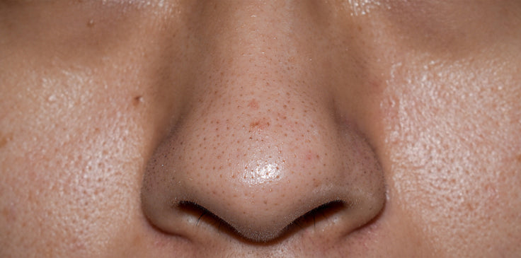 Clogged Nose Pores? Here’s What to Do.