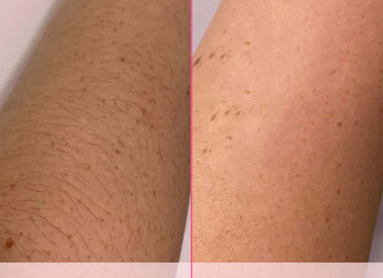 IPL Hair Removal: What To Expect Before And After