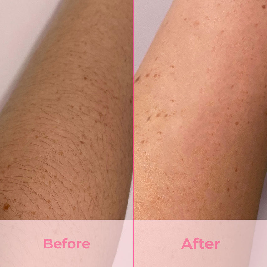 I tried at-home IPL hair removal, and I'm never going in-salon