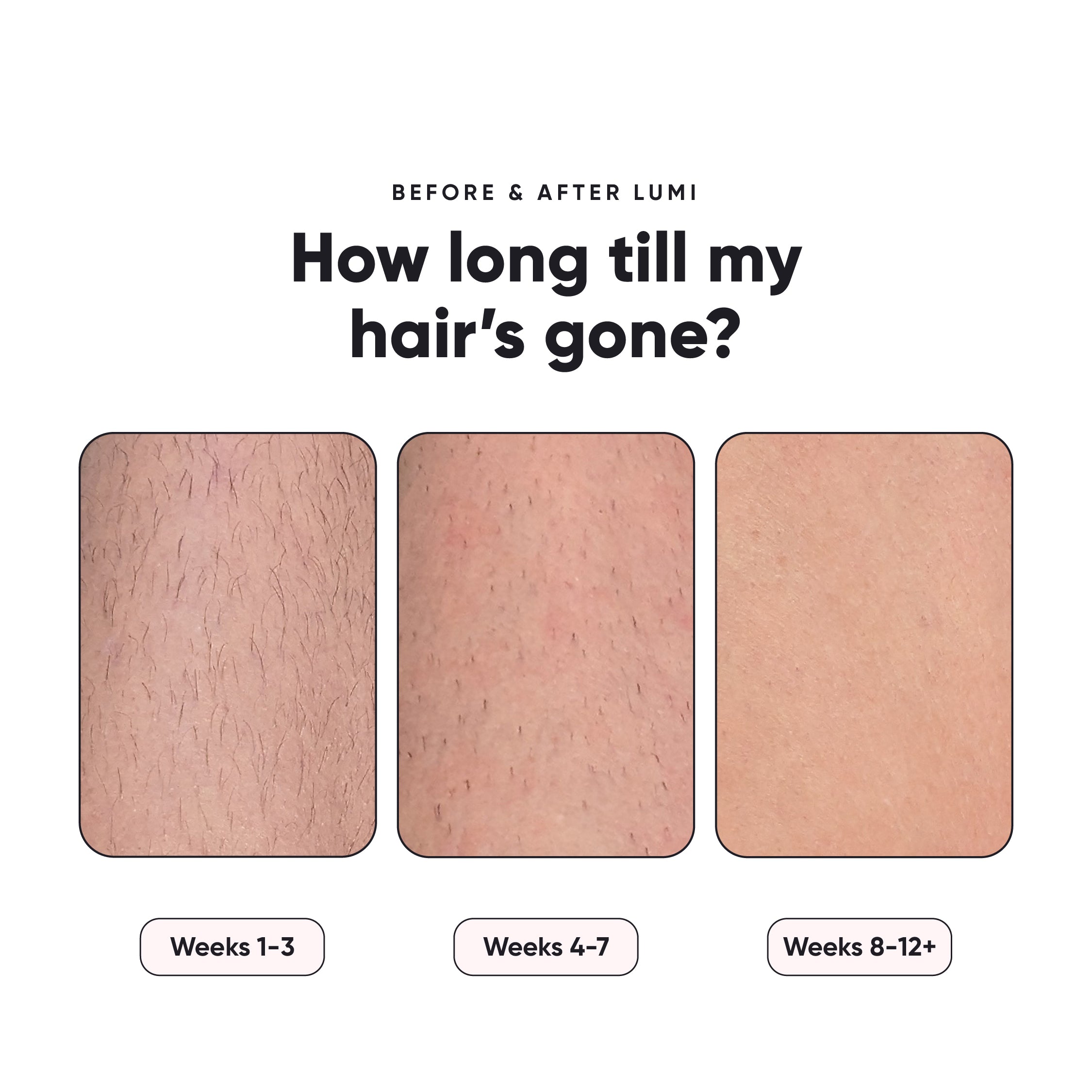 Lumi - Permanent Hair Removal Device – RoseSkinCo.
