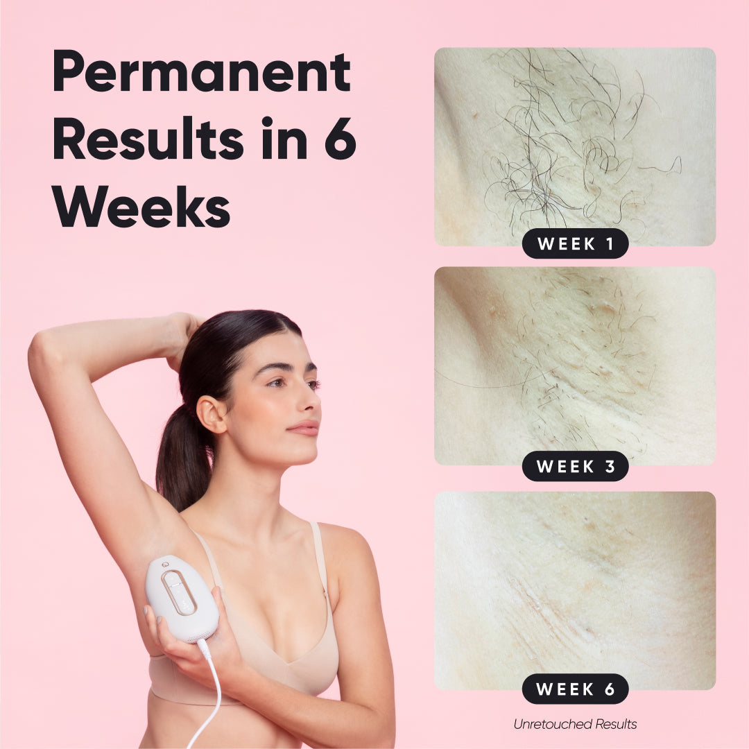 Lumi 2 - The #1 Permanent Hair Removal Device – RoseSkinCo.